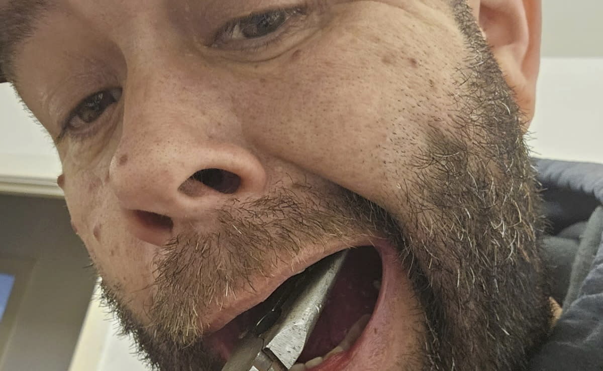 Chris Langston was unable to cope with the unbearable pain his tooth was causing, so he took matters into his own hands and pulled it out with pliers. (Chris Langston / SWNS)
