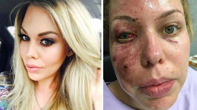Beauty queen Felicia Djamirze claims she has suffered third degree burns and may lose sight in one eye after a flash grenade lobbed into a Queensland home by police exploded in her face.