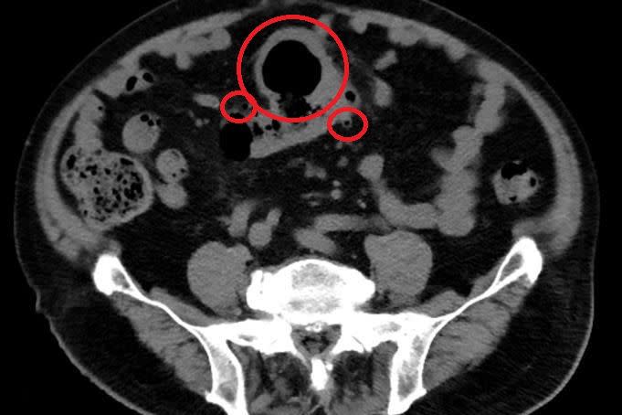 電腦斷層顯示大腸已有多處憩室