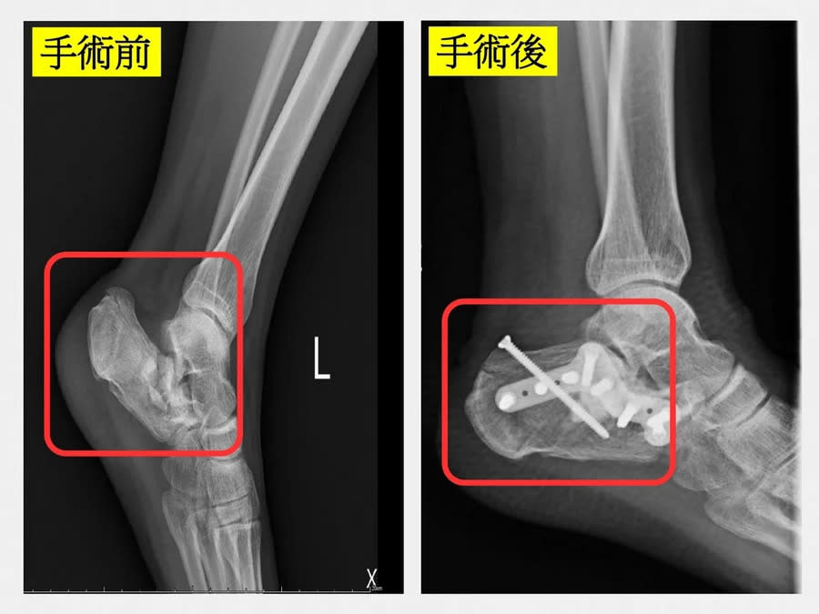 微創手術減少併發症