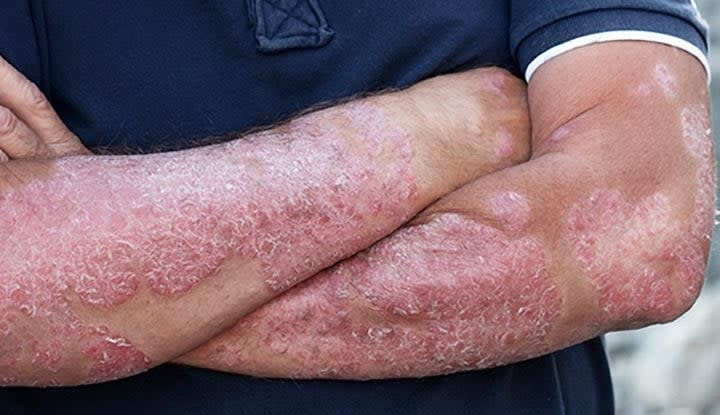 Psoriasis: What It Is, Symptoms, Causes, Types & Treatment