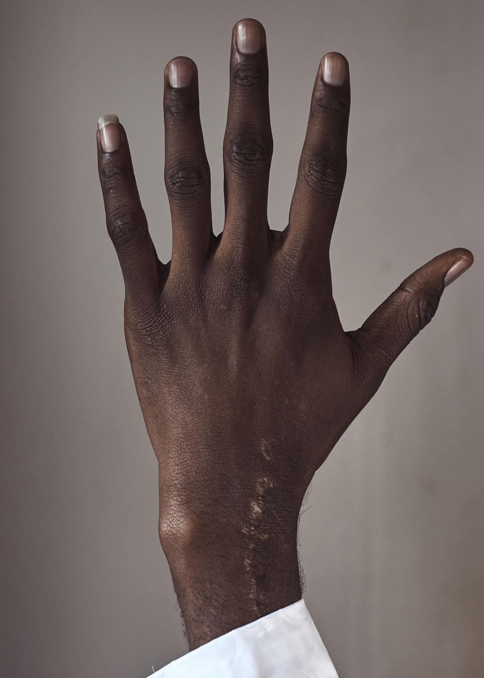 Abdoul, 32 year-old migrant from Maghama, Mauritania poses for a photograph showing surgery scars after treating injuries alleged inflicted by Mauritanian Police on Friday, Oct. 6, 2023, in New York. Abdoul traveled from Mauritania to New York via Istanbul, Bogota, El Salvador, Nicaragua, Honduras, Guatemala, Mexico and crossed the U.S. southern border in Texas on July 4, 2023. Abdoul is one of more than 8,000 migrants who have been jailed on criminal trespassing charges at the Texas border since Gov. Greg Abbott began authorizing the arrests in 2021. (AP Photo/Andres Kudacki)