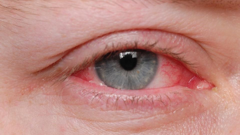 A close-up of a blue-eyed person with conjunctivitis and redness