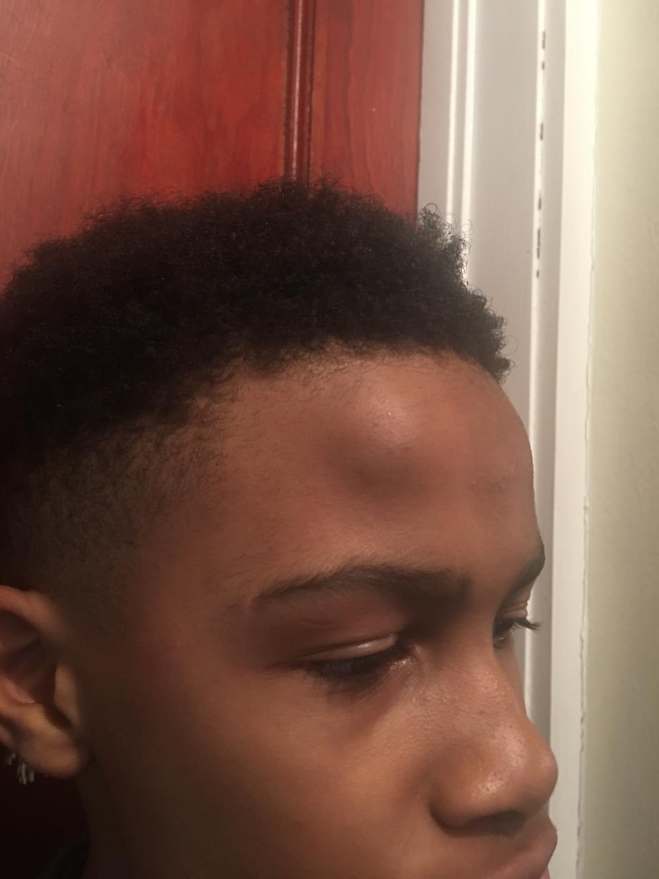 Israel Bolton, 12, was left with a head injury after an incident with a classmate and an alleged assault by a teacher, who used the N-word. (Photo: Courtesy of Quentin Bolton)