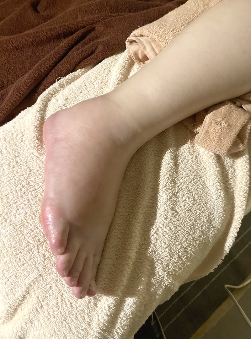 療程前孕媽咪後期腳踝水腫實際案例