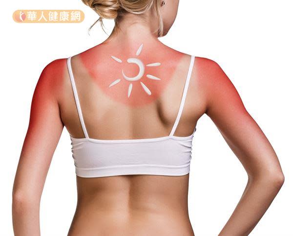曬傷在中醫被視為「熱毒」的外顯症狀，是皮膚在強烈太陽光照射下所引起的急性損傷。