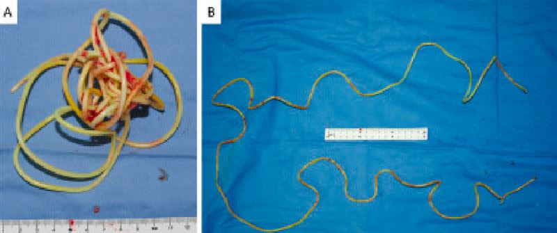 跳繩成功從老翁體內取出。（圖／翻攝自Urology Case Reports）