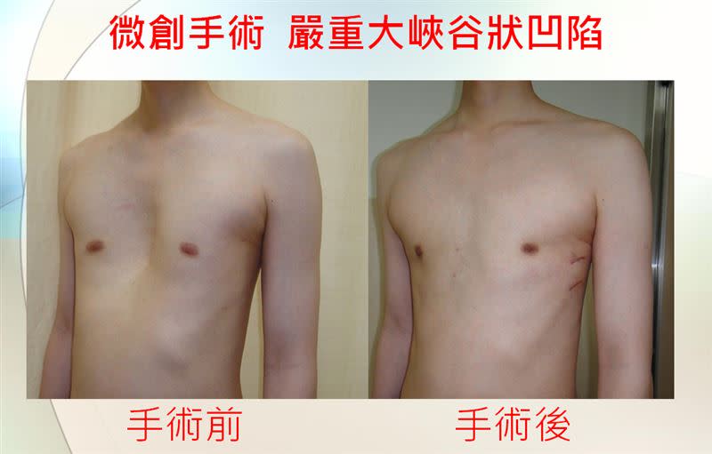 三總透過微創手術可有效改善漏斗胸（圖／三軍總醫院提供）