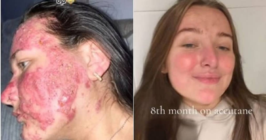 英國21歲女子瓊斯曾因豆花臉被霸凌。（圖／翻攝自TikTok）