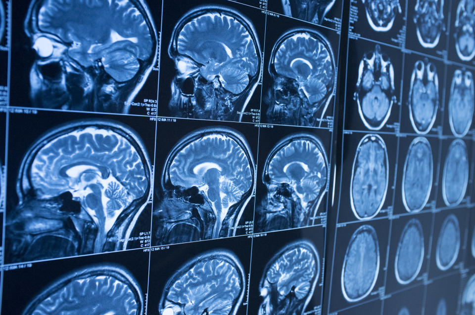 MRI brain scan (iStockphoto/Getty Images)