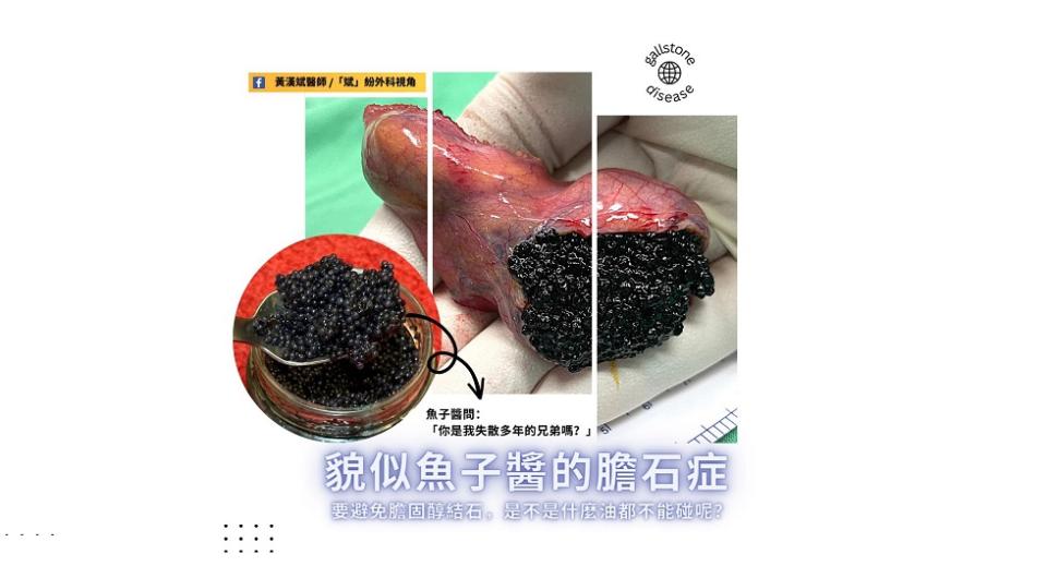 膽石症經由腹腔鏡膽囊切除術取出滿滿黑色結石，猶如魚子醬。圖片授權自<a href="https://www.facebook.com/Dr.Wong.Hon.Phin" rel="nofollow noopener" target="_blank" data-ylk="slk:黃漢斌醫師;elm:context_link;itc:0;sec:content-canvas" class="link ">黃漢斌醫師</a>