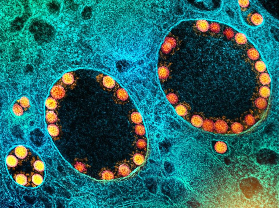 Because the virus that causes COVID-19 (gold) and other RNA viruses enter cells through endosomes, mRNA drug impurities can elicit similar immune responses. <a href="https://flic.kr/p/2mrqrnx" rel="nofollow noopener" target="_blank" data-ylk="slk:NIAID/Flickr;elm:context_link;itc:0;sec:content-canvas" class="link ">NIAID/Flickr</a>, <a href="http://creativecommons.org/licenses/by/4.0/" rel="nofollow noopener" target="_blank" data-ylk="slk:CC BY;elm:context_link;itc:0;sec:content-canvas" class="link ">CC BY</a>