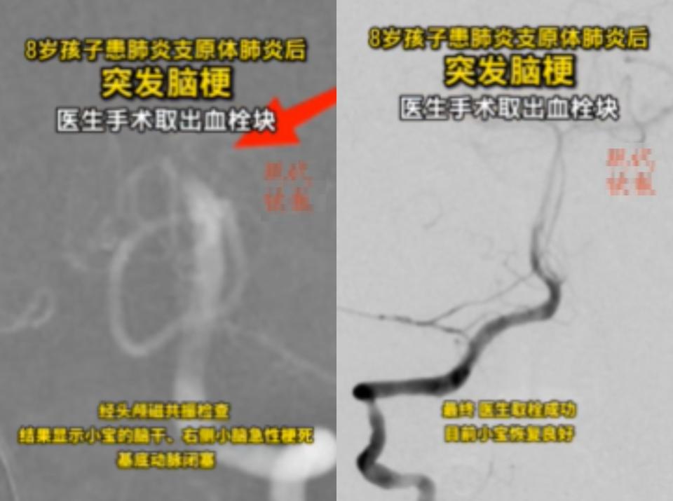 中國大陸8歲男童感染黴漿菌肺炎，衍生明顯肺質變。（圖／翻攝自微博）