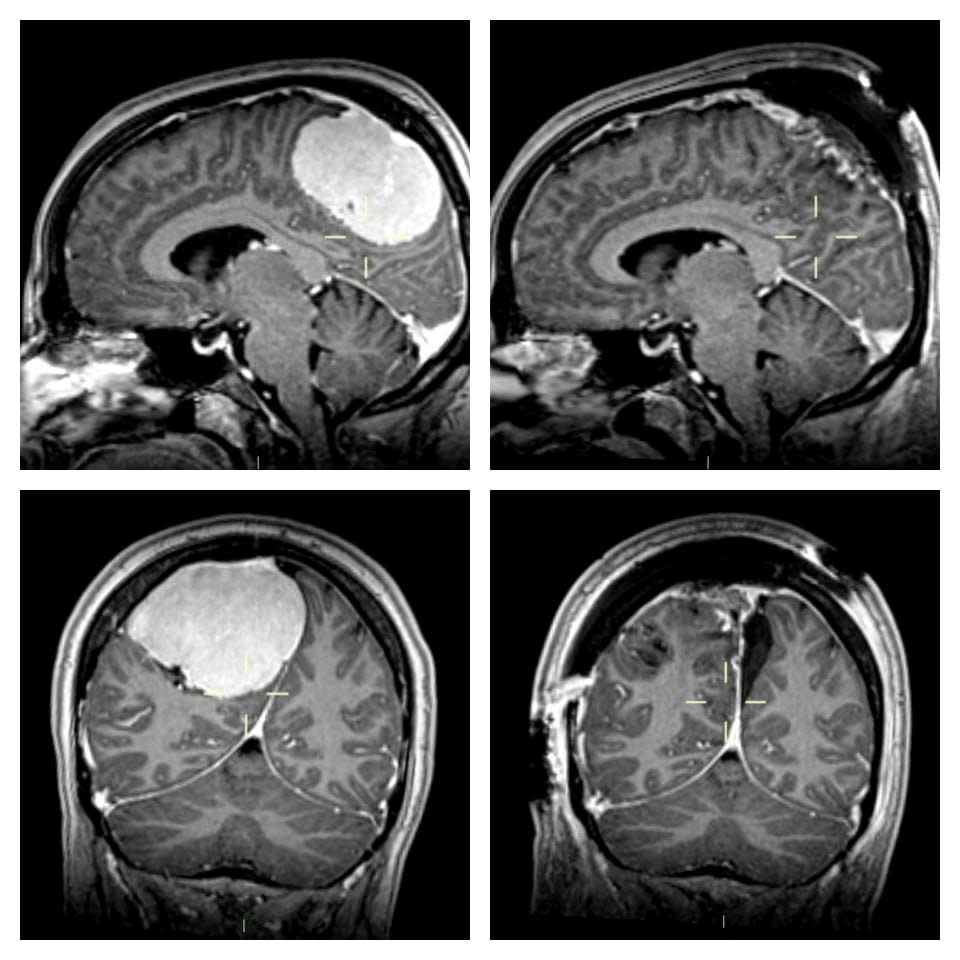 Lisa Dumbiotis&#39; brain tumour scan. (SWNS)

