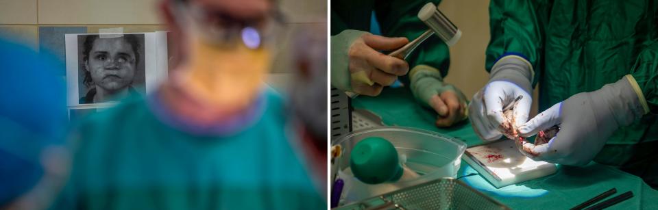 LEFT: A photo of Amedy Dewey, 23, is taped inside a surgery room during her facial reconstruction surgery at the University of Michigan Health C.S. Mott Children's Hospital in Ann Arbor on Monday, July 24, 2023. RIGHT: Hannes Prescher, a craniofacial surgery fellow, left, Christian Vercler, plastic surgeon, center, and an integrated plastic surgery resident, Emily Graham, perform a facial reconstruction surgery on Amedy Dewey.