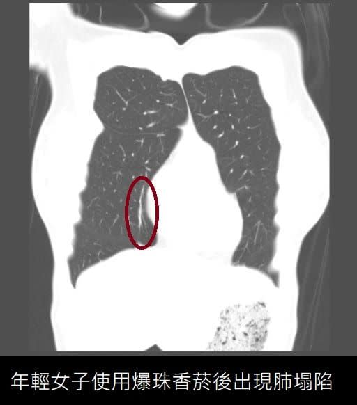 ▲蘇一峰分享30歲女病患肺部電腦斷層照。（圖／翻攝蘇一峰臉書）