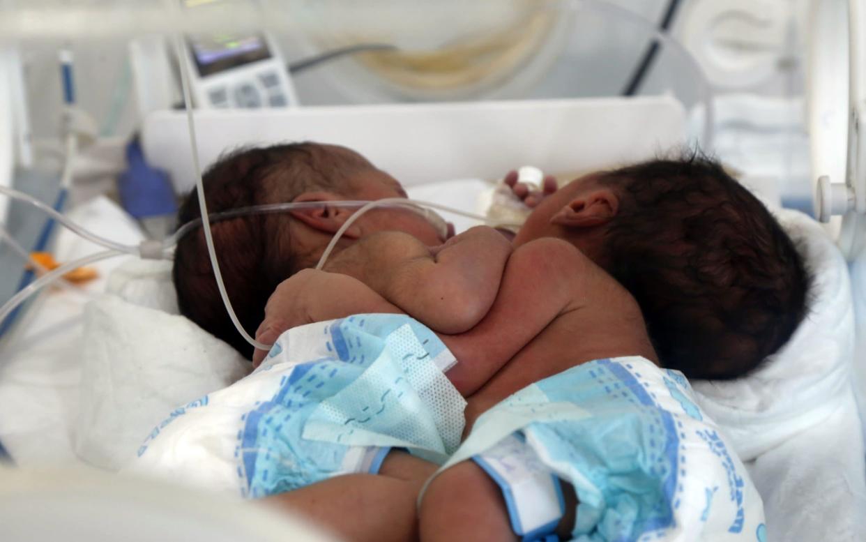 Conjoined twins, who were born in Sanaa, seek help from the United Nations (UN) to be treated abroad - Anadolu Agency /Anadolu 