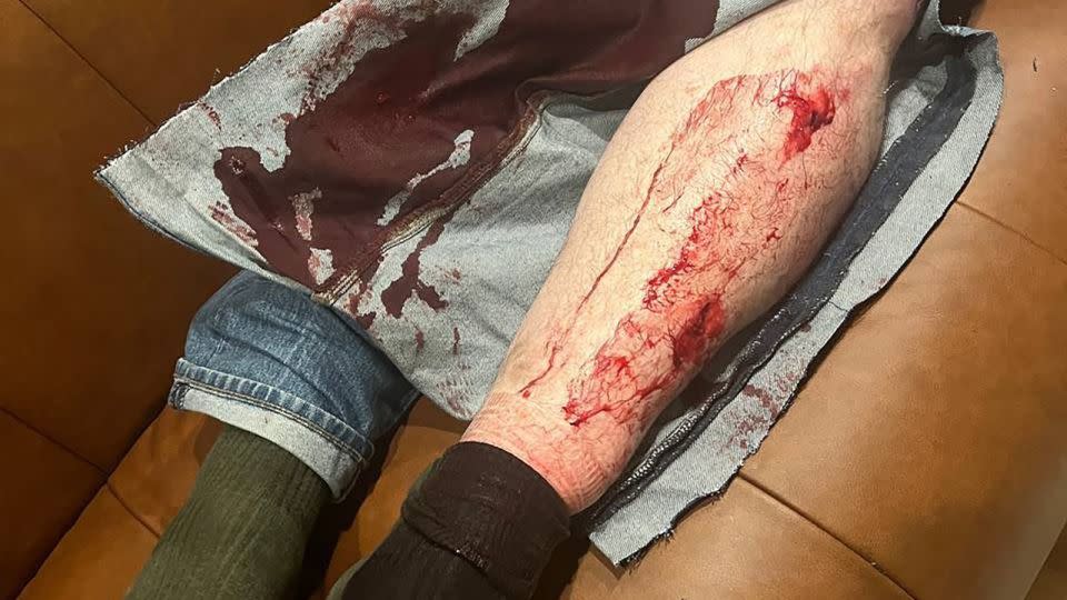 Leonid Volkov's injuries after he was attacked with a hammer outside his home. - N/A/Ivan Zhdanov/elegram