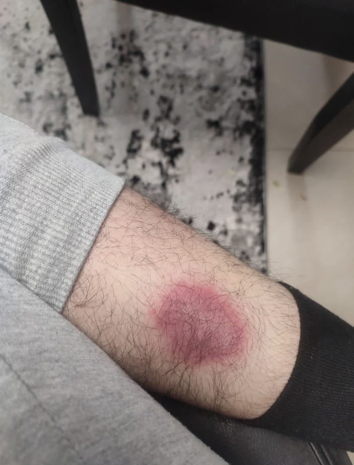Person's forearm with a noticeable red rash or skin irritation visible