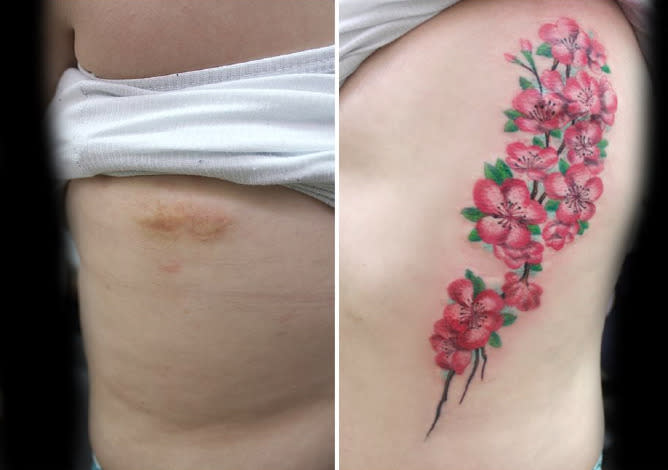 Varicose veins cover up tattoo  varicose veins  Certainly a creative way  to deal with the cosmetic side of varicose veins  Credit Julya Art  By  The Varicose Vein Clinic  Facebook