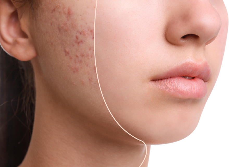 Acne-Before-After-Split-Stock-Photo