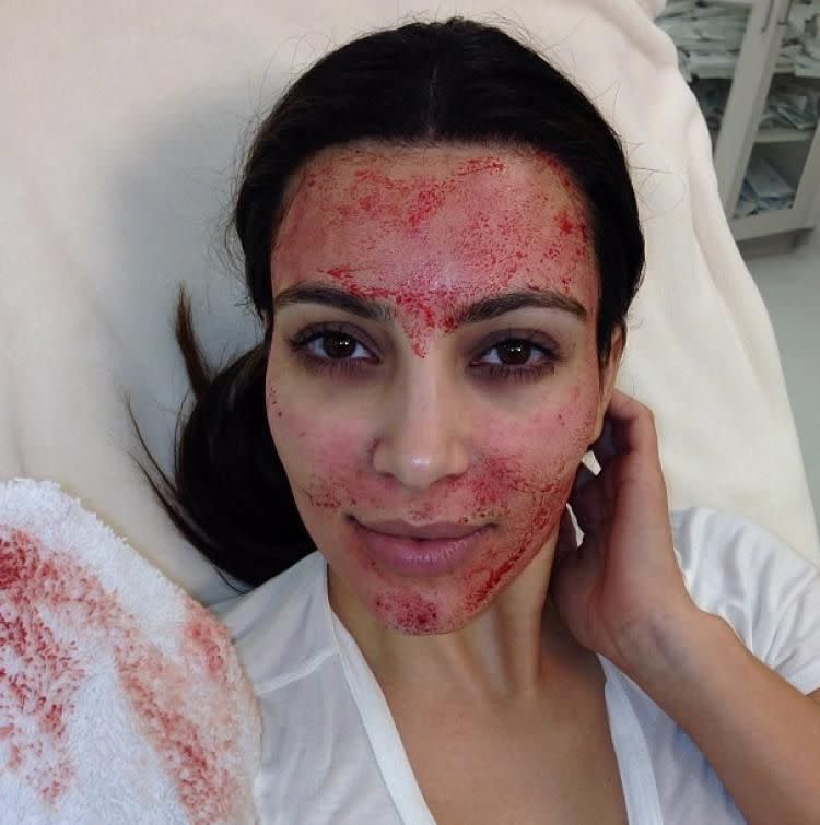 Kim Kardashian West is suing a Alabama-based doctor for using this photo and touting her image to promote the popular 'Vampire Facial' cosmetic procedure. | Kim Kardashian/Instagram