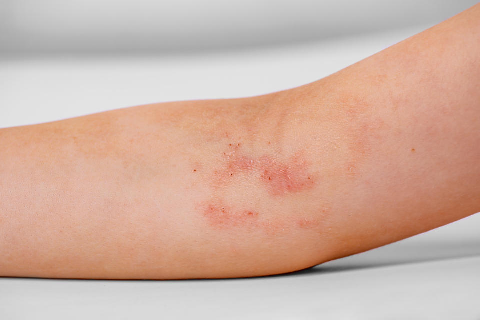 幼兒異位性皮膚炎怎麼照顧？異位性皮膚炎原因、症狀一篇看懂（圖／Getty Images）