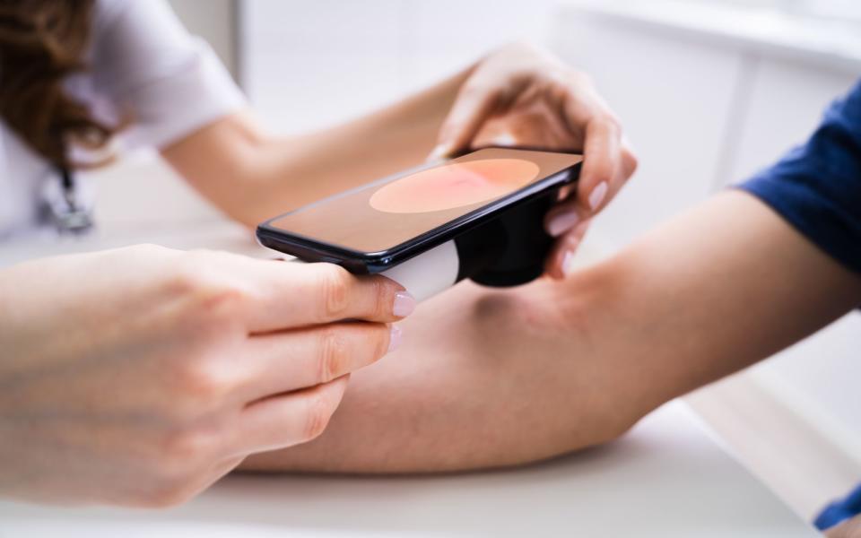 Auch Hautärzte nutzen Smartphones, um Hautkrankheiten zu diagnostizieren. Nun sollen sich Patienten bereits zu Hause  selbst untersuchen können. (Bild: iStock/AndreyPopov)