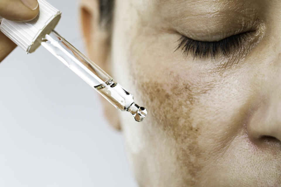 Close-up of a person's face with freckles or pigmentation spots, as they use a dropper to apply skincare serum to their cheeks