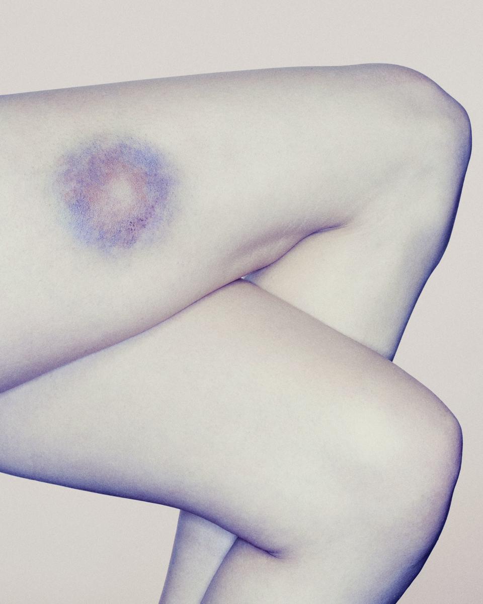 <p>We’ve all been there - a shin to a coffee table or a gnarly crash can leave you with a few black-and-blue marks. But what is a bruise, exactly? </p><p>“A bruise is a reflection of minor injury to the blood vessels under the surface of the skin. If these vessels are damaged, a small amount of blood can leak out, giving the classic blue, black, or purple discoloration,” says <a rel="nofollow noopener" href="https://my.clevelandclinic.org/staff/14908-cory-fisher" target="_blank" data-ylk="slk:Cory Fisher, D.O.;elm:context_link;itc:0;sec:content-canvas" class="link ">Cory Fisher, D.O.</a>, family medicine physician at the Cleveland Clinic. </p><p>But what if you seem to be bruising easily, developing bruises on your legs, arms, and other parts of your body from even just a slight bump, or seemingly out of nowhere? Keep reading to find out what else could be causing your unexplained bruising - and how to heal a bruise faster. </p>