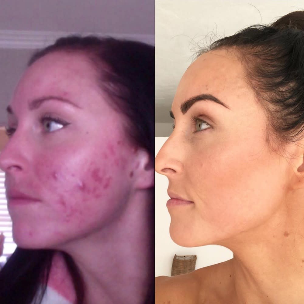 This food blogger kept it real about her cystic acne scars in this powerful before and after post