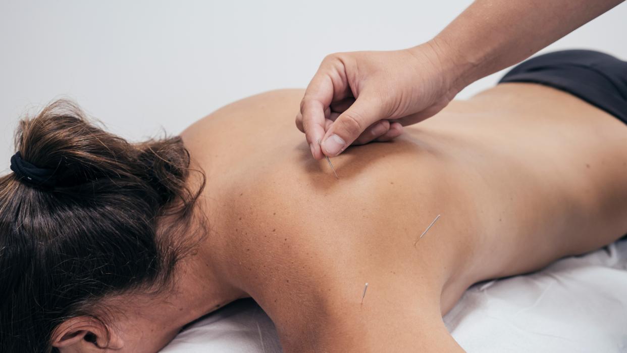  woman receiving a dry needling treatment 