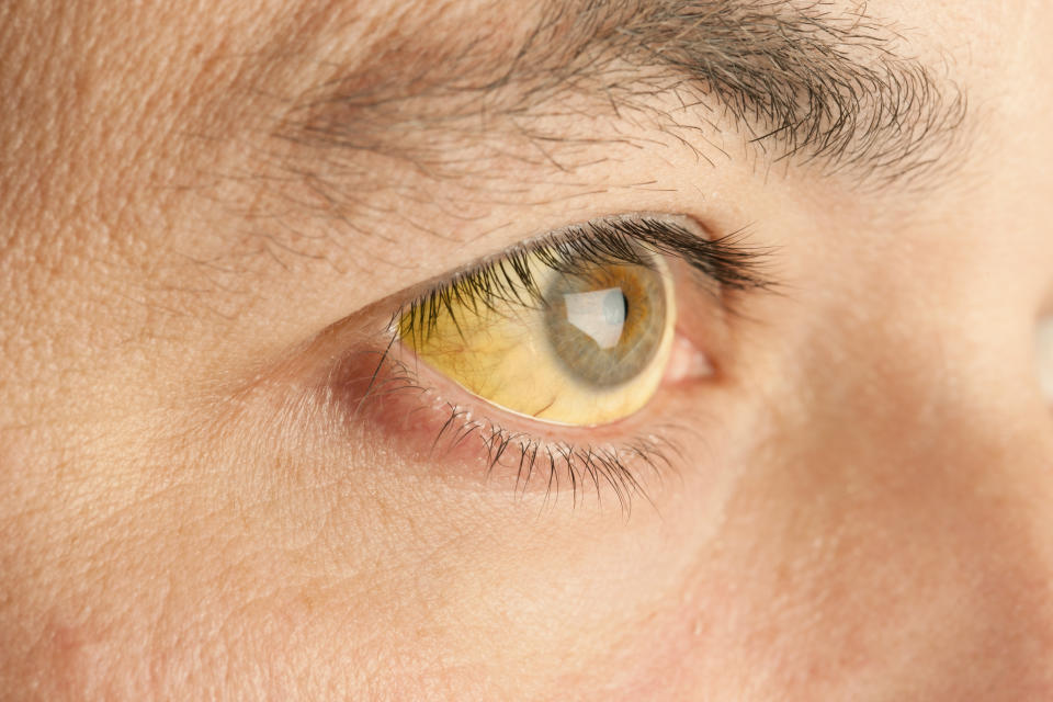 Jaundice symptoms, yellow skin and eyes. (Getty Images)