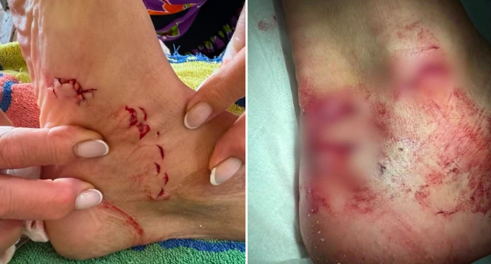 Images of Troy Brown's shark bites on his foot and ankle.