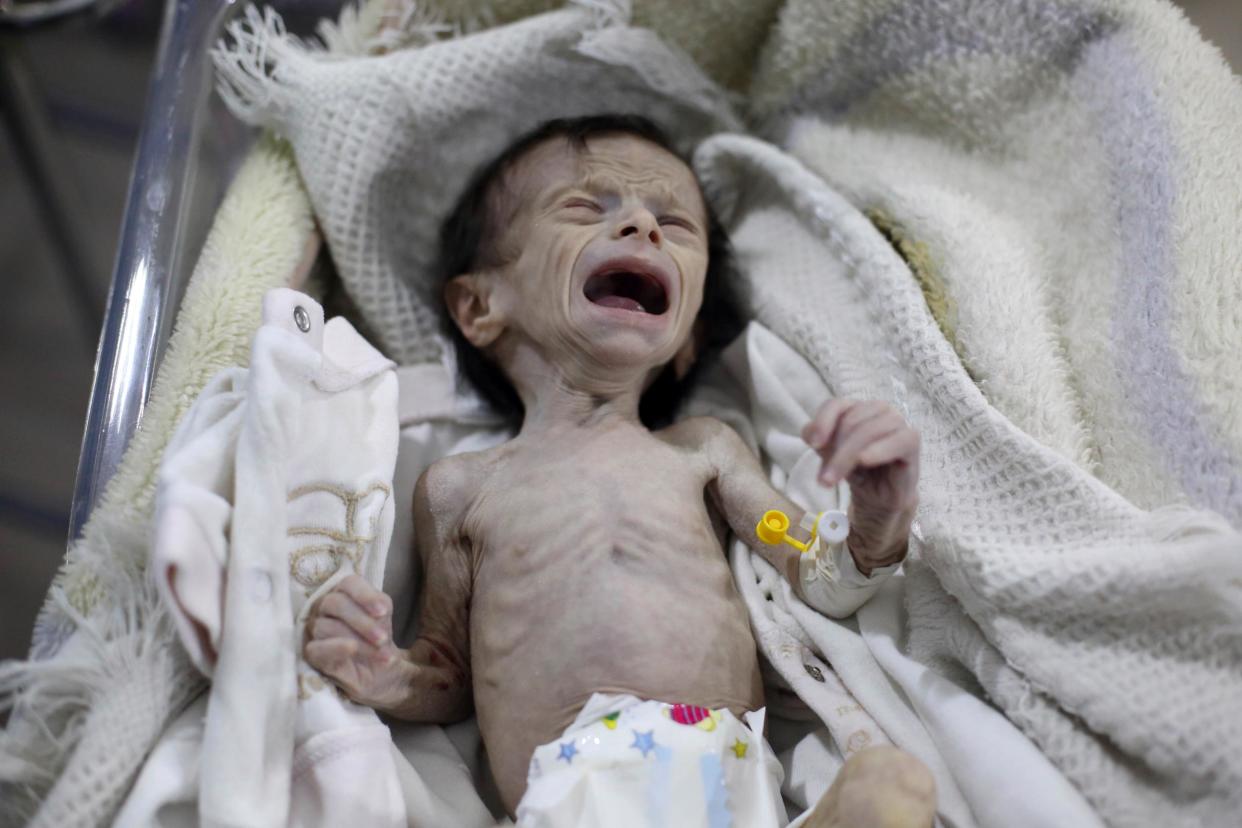 Acutely malnourished Samar Dofdaa was taken to a clinic by her parents in besieged East Ghouta on Saturday. She died the next day: AFP/Getty Images