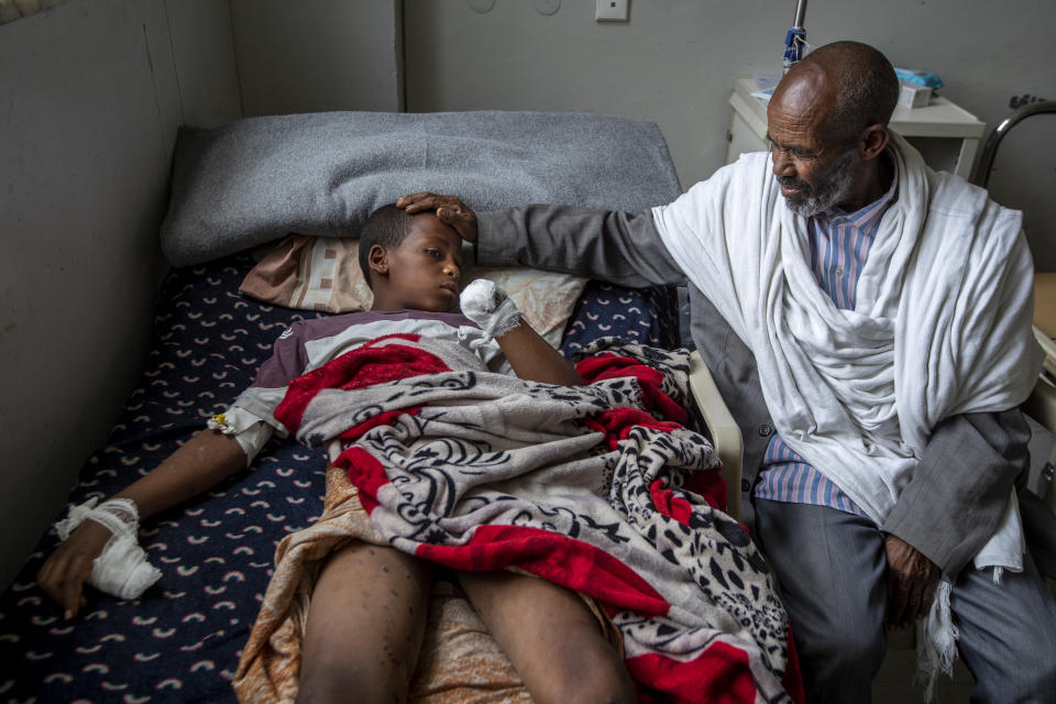 Haftom Gebru, 12, who was wounded and had his hand amputated after an artillery shell hit a pile of stones in his family's compound in Hawzen during Orthodox Easter, is comforted by his father, Gebru Welde Abrha, 60, right, as he lies in his hospital bed at the Ayder Referral Hospital in Mekele, in the Tigray region of northern Ethiopia, on Thursday, May 6, 2021. When Welde Abrha saw the wound in the boy’s left hand, he knew it would have to be cut off. “I am so sad I can’t explain it. ... I feel it deeply.” (AP Photo/Ben Curtis)