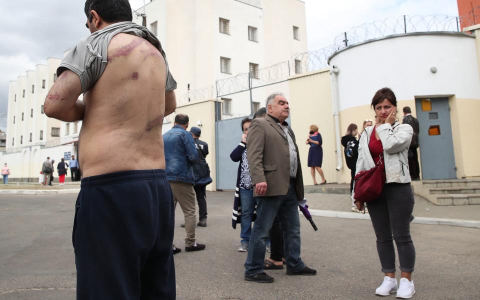 Vardan Grigryan, detained during a mass protest, lifts his shirt to show injuries after being released from a temporary detention facility