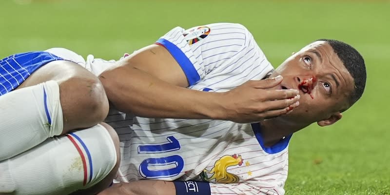 Mbappé zog sich im Auftaktspiel gegen Österreich eine schlimme Verletzung an der Nase zu<span class="copyright">Anadolu via Getty Images</span>