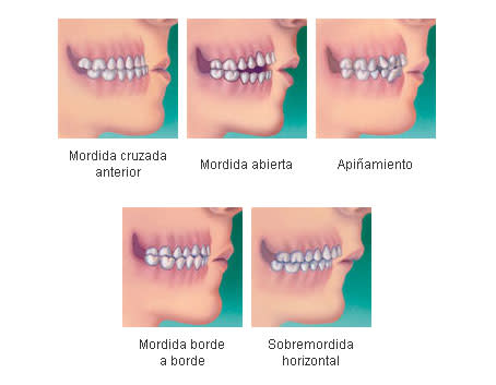 Partes de la ortodoncia con brackets - Clínica Ortodent