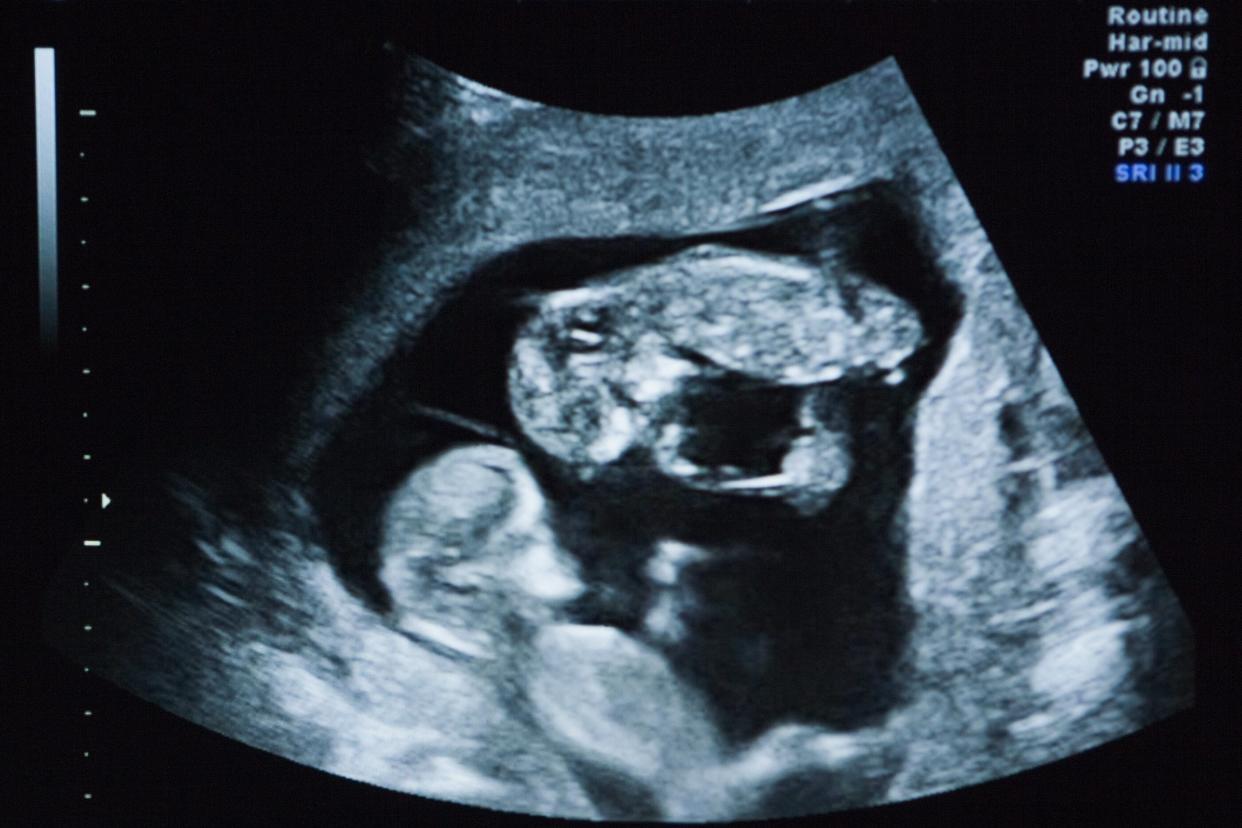 ultrasound photo of twins