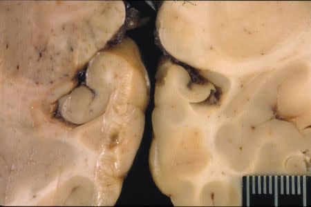 A normal California sea lion brain section (L) and California sea lion brain that has been affected by domoic acid exposure (R) with the shrunken hippocampus in the center of the brain section are shown in this undated image courtesy of the Marine Mammal Center in Sausalito, California released on December 14, 2015. REUTERS/The Marine Mammal Center/Handout via Reuters