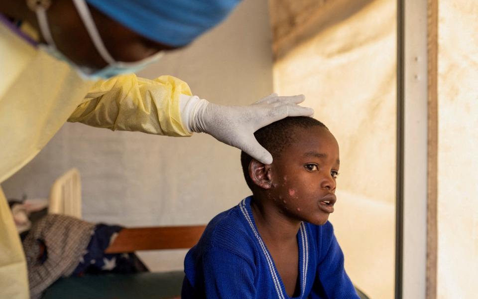 There have been 27,000 mpox cases and more than 1,100 deaths, mainly among children, in Congo since the current outbreak began in January 2023