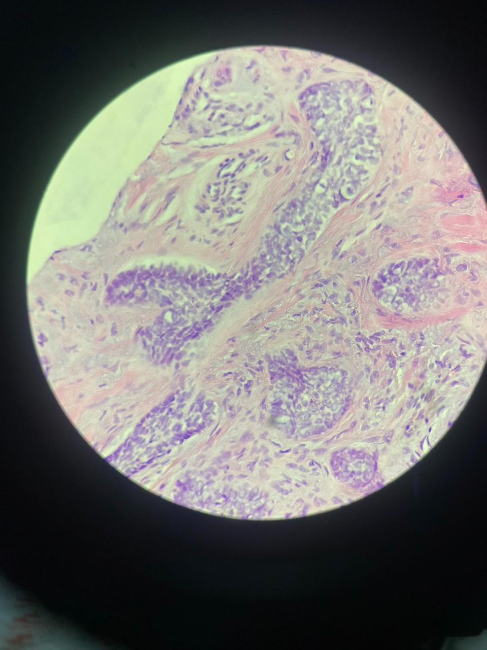 基底細胞癌檢體在顯微鏡下呈現的畫面。為恭醫院提供