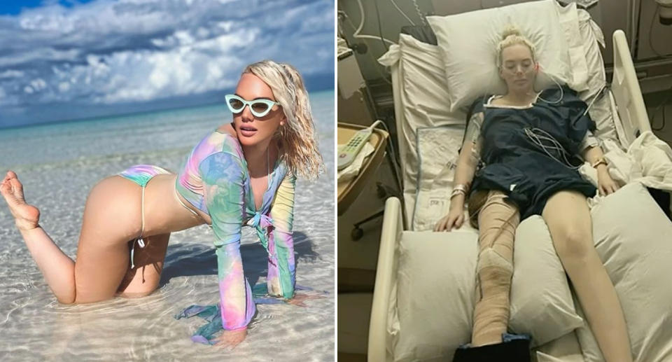 Jennifer Barlow in the ocean in the Bahamas, where she contacted the flesh-eating bacteria. Jennifer in a hospital bed with a withered right leg.
