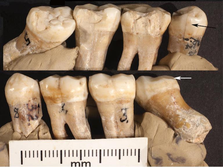 Neanderthals attempted dentistry 130,000 years ago, believe scientists