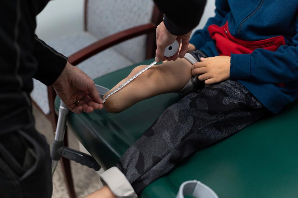 Saleh Humaid, 8, of Gaza, has a section of his leg measured by Anew Life Prosthetics and Orthotics certified prosthetist and orthotist Matt Warner before having a prosthetic made at Anew Life Prosthetics and Orthotics in Detroit on Tuesday, June 13, 2023. Humaid lost part of his leg from shrapnel after a drone strike hit a car as he passed it while driving with his father. He has traveled to the U.S. with the help of the Palestine Children's Relief Fund to receive free medical treatment and a new prosthetic leg along with rehab before returning home.