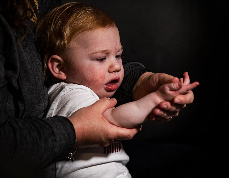 Wesson Keene, 1, protests a bit while his mother helps him with range-of-motion exercises during a recent therapy session at their home in Lexington, Ky. Wesson's right arm is affected by his cerebral palsy.