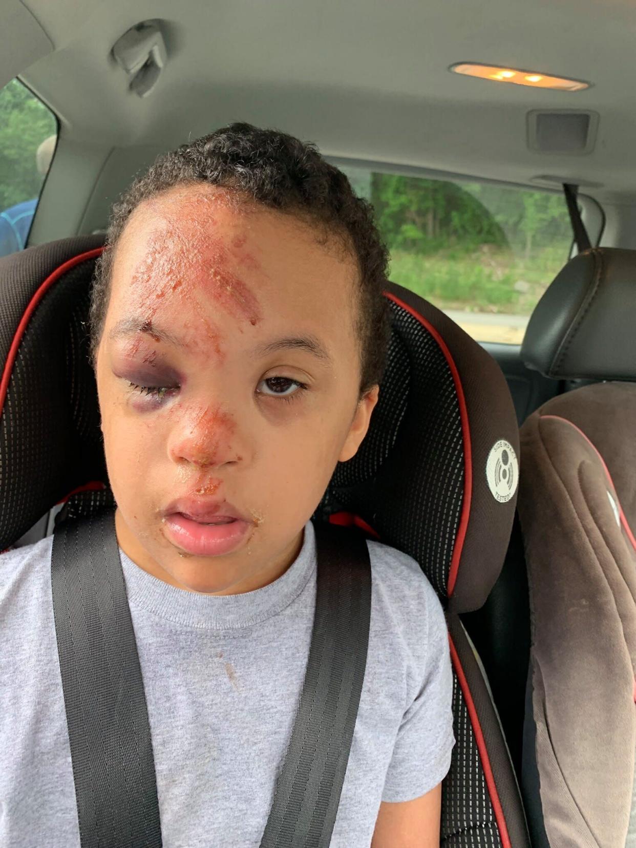 Young boy with Down Syndrome was injured on a school bus, and the school refused to provide video footage from the bus to the boy's family. (Credit: Angel Rivera/Facebook)