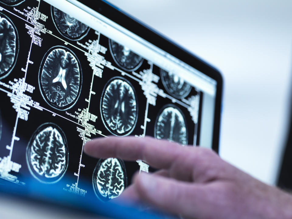 A doctor points towards a screen showing brain scans. (Photo via Getty Images)