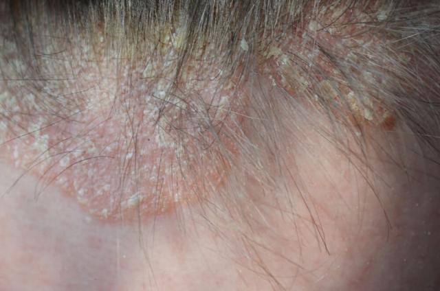 mild scalp psoriasis symptoms